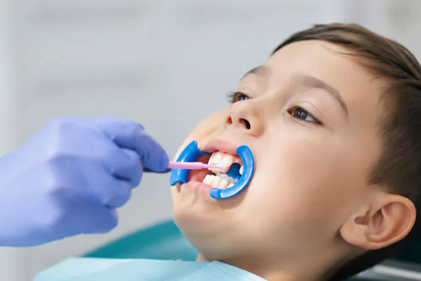 Dental sealants applied to teeth at Lakeside Dental